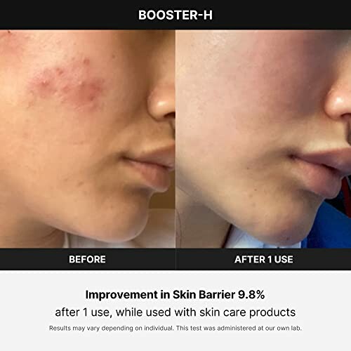 Before and after skin barrier improvement on face.